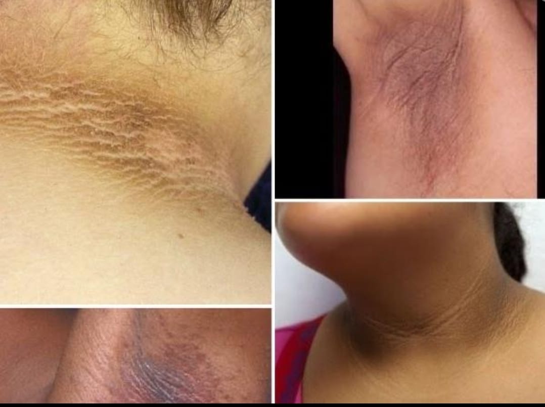 Aichun Beauty, crema blanqueadora de articulaciones para eliminar manchas, rodillas y codos oscuros